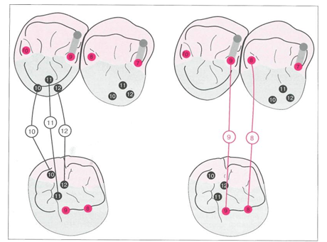 Схема окклюзионных контактов зуба 45 с зубами-антагонистами 14 и 15 при I классе окклюзии поЭнглю.