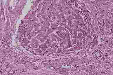 Алкогольный монолобулярный цирроз печени (секционный случай, окраска г/э, х200). Ложная долька, окруженная прослойкой фиброзной ткани.