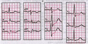 Рис. 6. ЭКГ при заднедиафрагмальном инфаркте миокарда: а - схема возникновения инфаркта; б - ЭКГ.